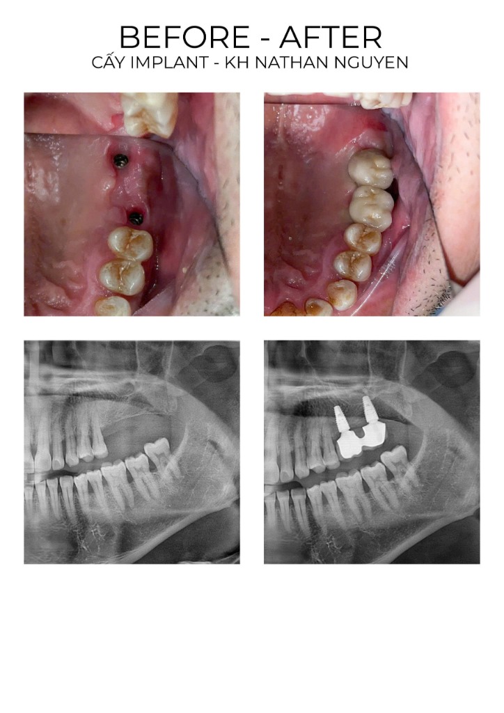 Ca Implant 3